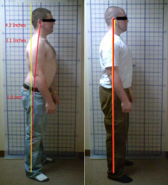 Chiropractic Hampton NH Case Study Chiropractic Hampton NH Case Study